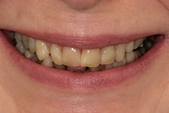 Smile Makeover - Case 3 before