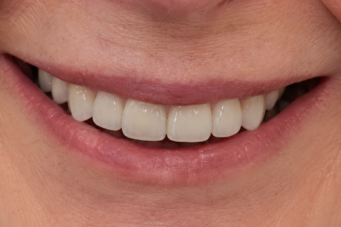 Smile Makeover - Case 3 after