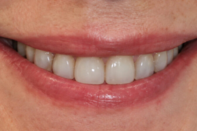 Tooth Wear - Case 1 after
