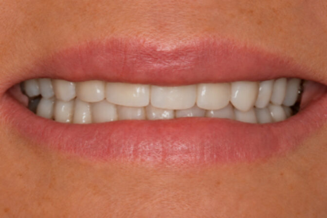 Smile Makeover - Orthodontics and Veneers after