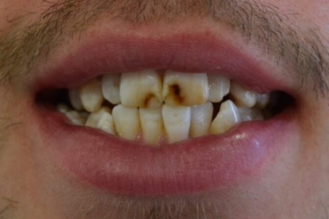 Composite Bonding - Case 1 before