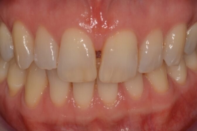 Composite Bonding - Case 2 before