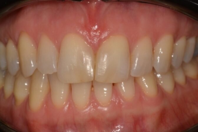 Composite Bonding - Case 2 after
