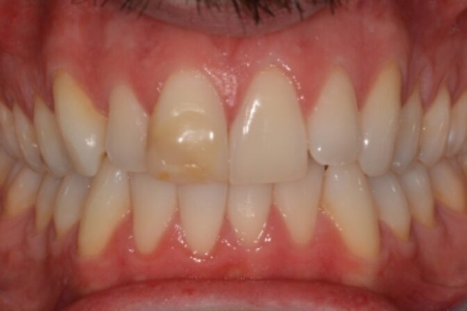 Composite Bonding - Case 3 before