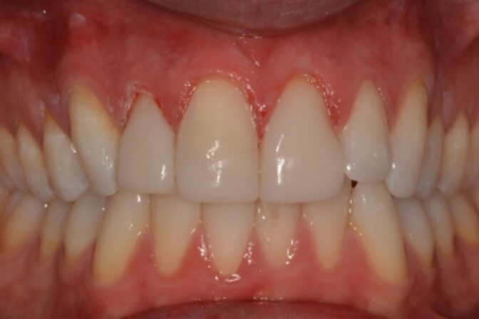 Composite Bonding - Case 3 after