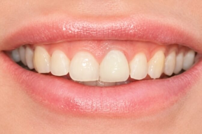 Composite Bonding - Case 4 before
