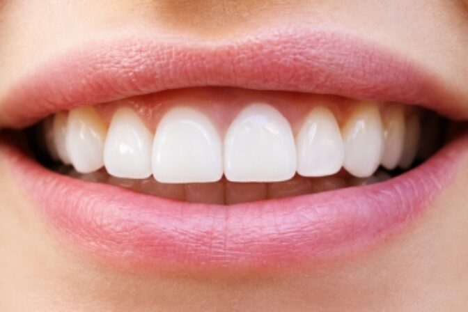 Composite Bonding - Case 4 after