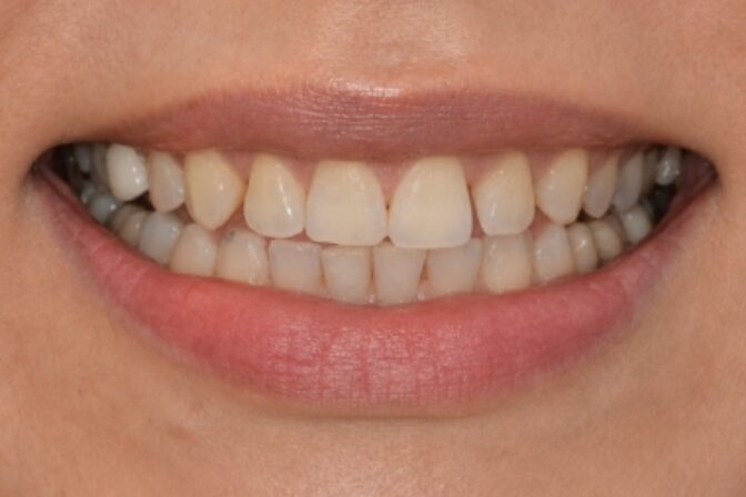 Composite Bonding - Case 5 before