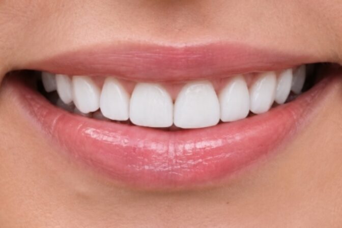 Composite Bonding - Case 5 after