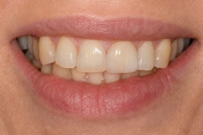 Composite Bonding - Case 6 before