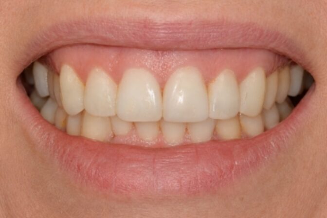 Composite Bonding - Case 6 after