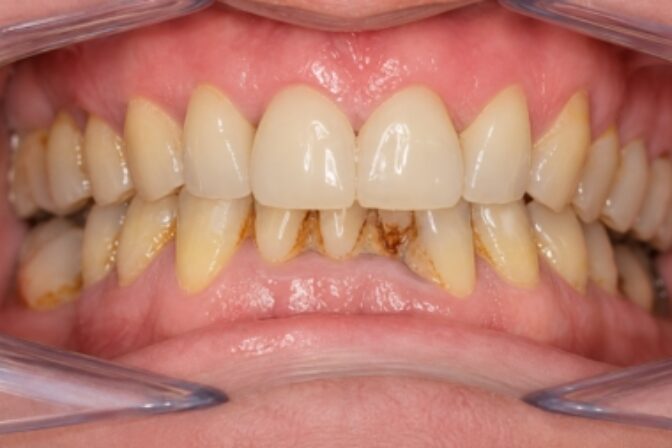 Composite Bonding - Case 8 after