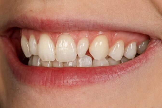 Composite Bonding - Case 9 before