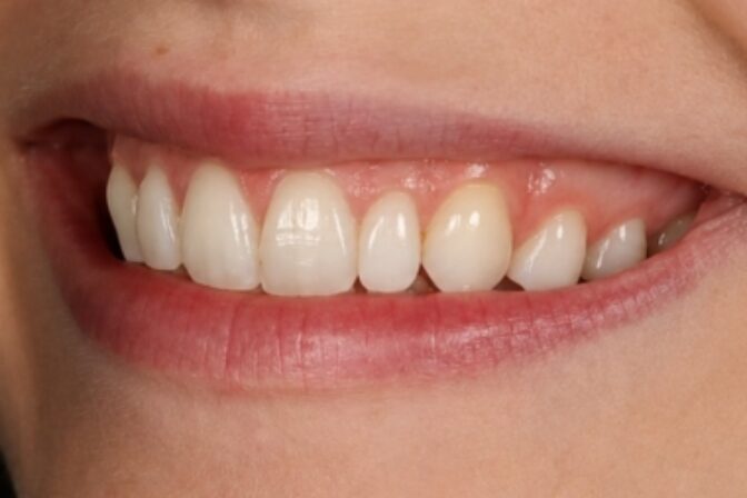Composite Bonding - Case 9 after