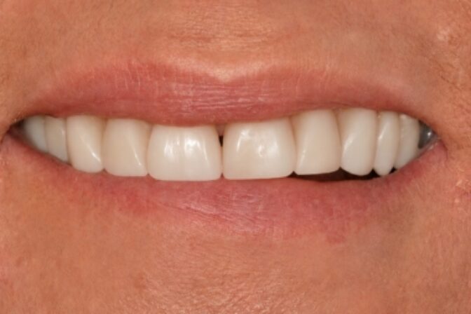 Composite Bonding - Case 10 after