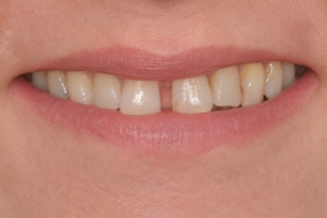 Composite Bonding - Case 10 before
