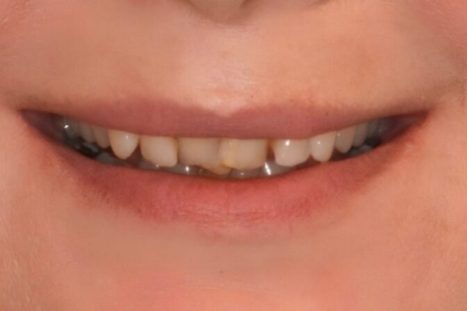 Composite Bonding - Case 11 before