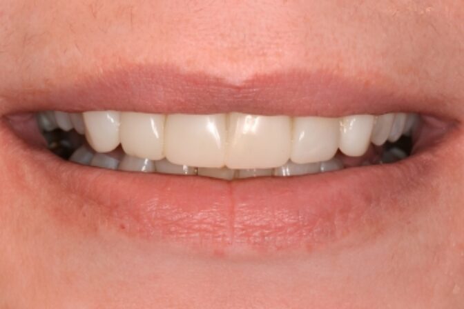 Composite Bonding - Case 11 after