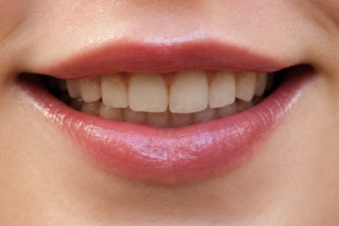 Composite Bonding - Case 12 before
