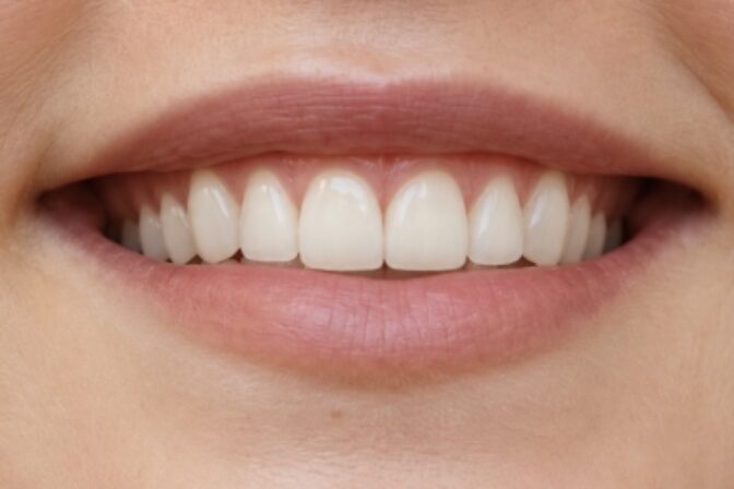 Composite Bonding - Case 12 after