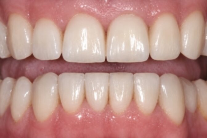Smile Makeover - Full Mouth Rehab - Case 1 after