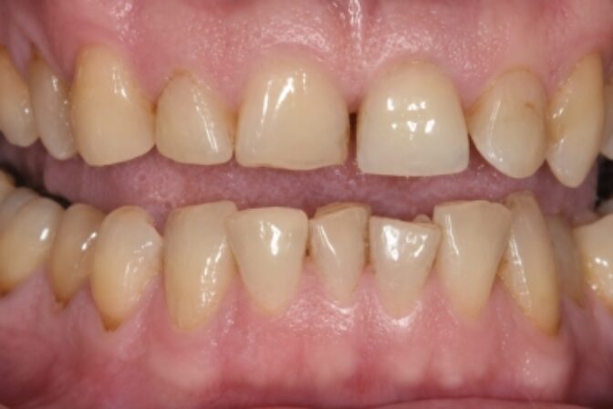 Smile Makeover - Full Mouth Rehab - Case 1 before