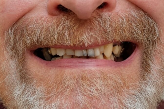 Smile Makeover - Full Mouth Rehab - Case 2 before