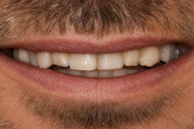 Smile Makeover - Full Arch Veneers and Crowns before