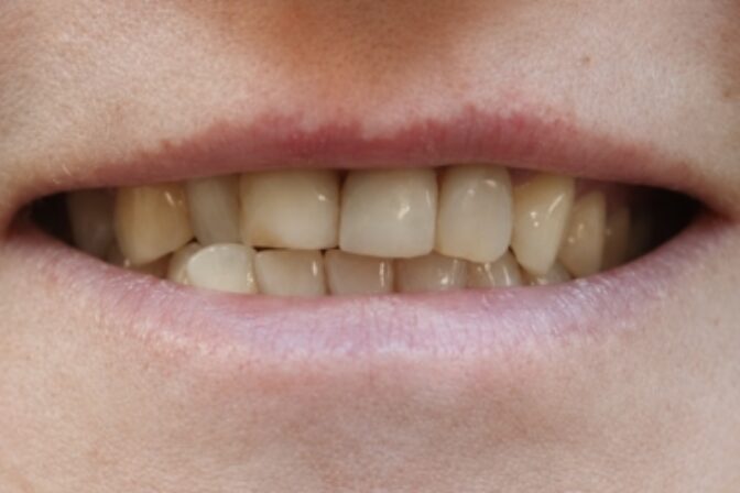 Smile Makeover - Orthodontics and Veneers before