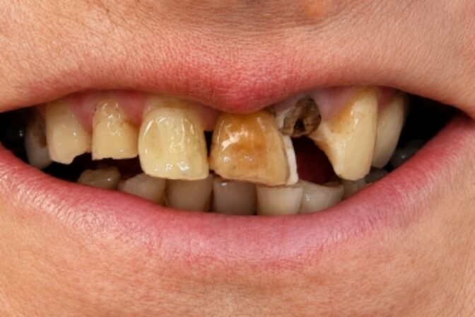 Smile Makeover case 1 before