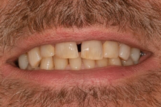 Smile Makeover – Full Arch Veneers and Crowns – Case 2 before
