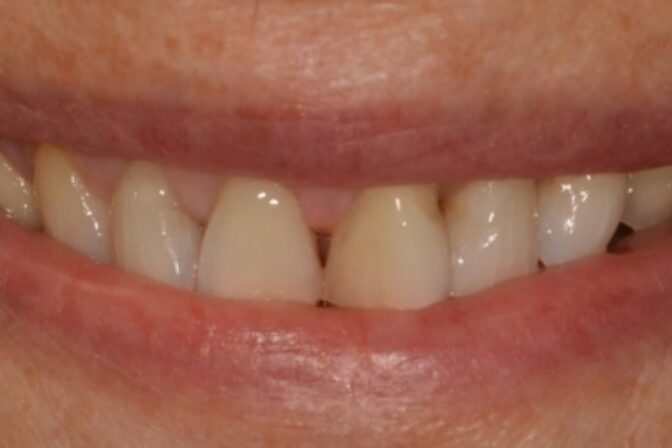Smile Makeover - Veneers before