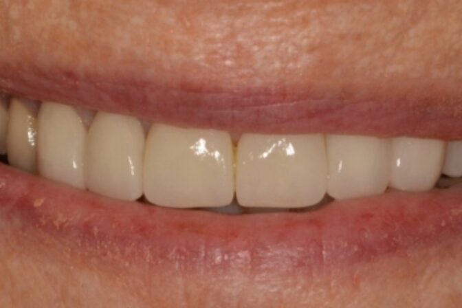 Smile Makeover - Veneers after