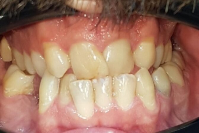 Smile Makeover - Case 5 before