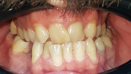 Smile Makeover - Case 5 before