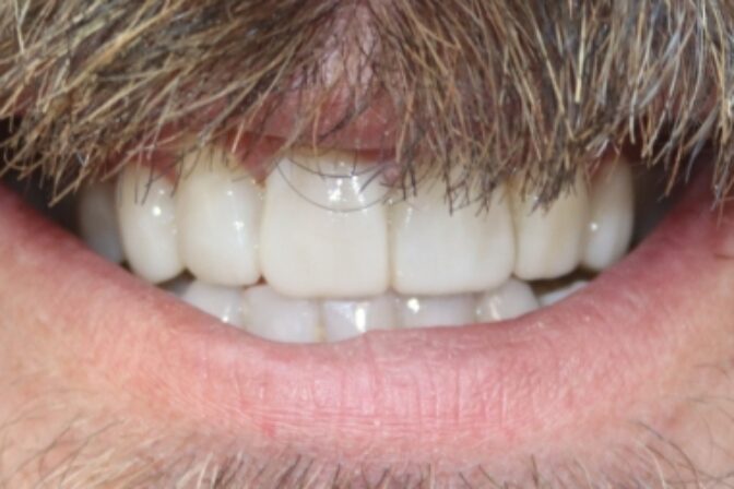 Smile Makeover - Case 5 after