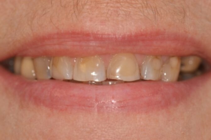 Tooth Wear - Case 1 before