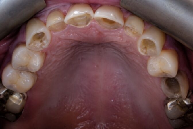 Tooth Wear - Case 2 before