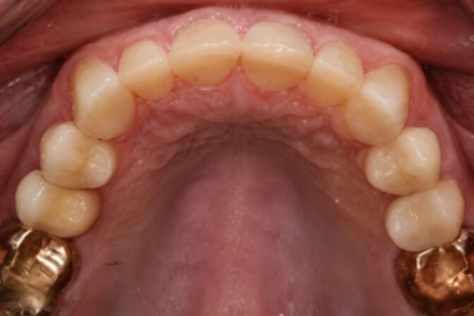 Tooth Wear - Case 2 after