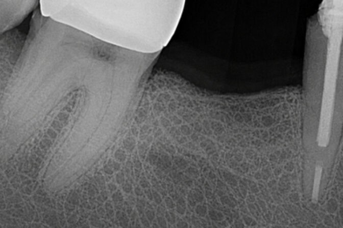 Dental Implants - Case 2 before