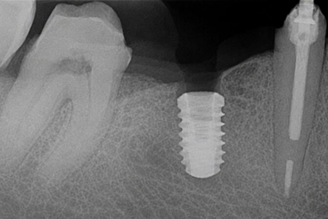 Dental Implants - Case 2 after