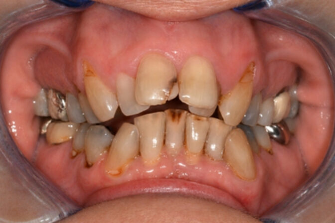 Orthodontics - Case 1 before