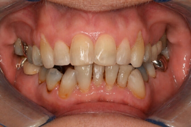 Orthodontics - Case 1 after