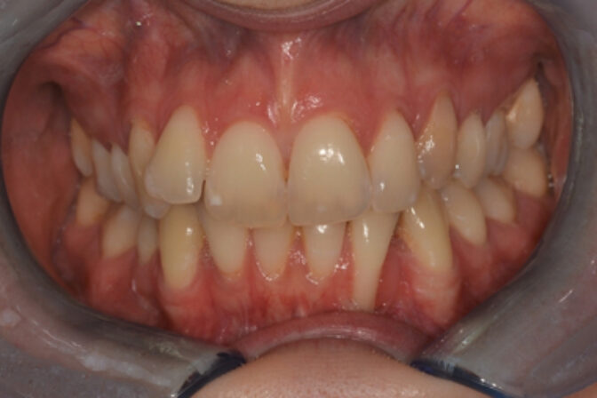 Orthodontics - Case 3 before