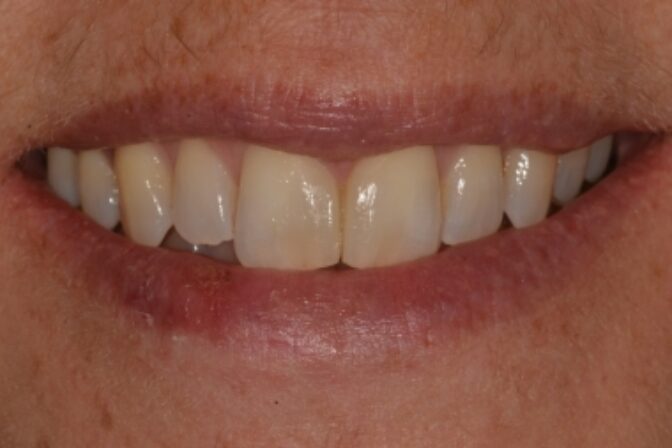 Composite Bonding - Case 2 after