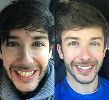 Invisalign case 3