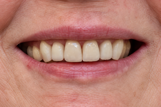 Smile Makeover - Case 12 after
