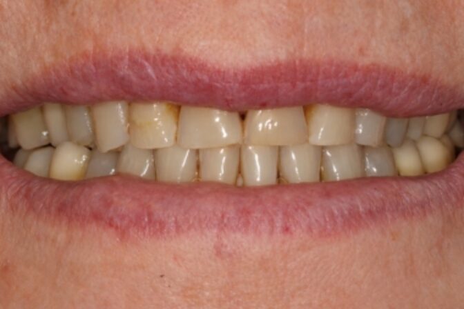 Smile Makeover - Case 13 before