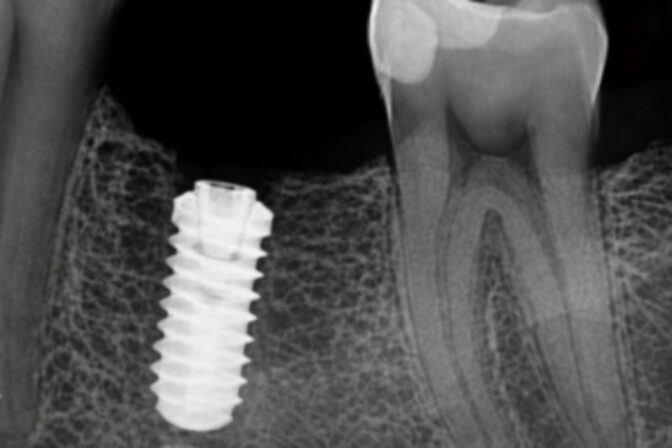 Dental Implants - Case 3 after