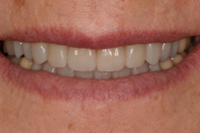 Smile Makeover - Case 13 after